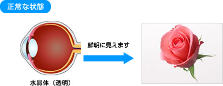 白内障の症状 治療法 和田眼科 兵庫県西宮市 今津駅