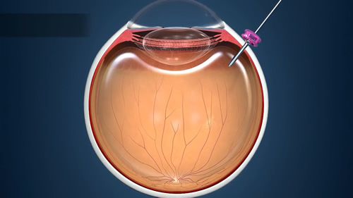 網膜硝子体手術イメージ