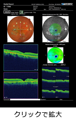 黄斑円孔の診断データ