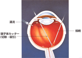 網膜硝子体手術イメージ